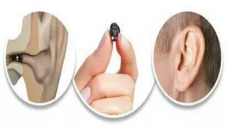Invisible Digital Hearing Aid by Stunning Smile Dental & Hearing Aid Clinic